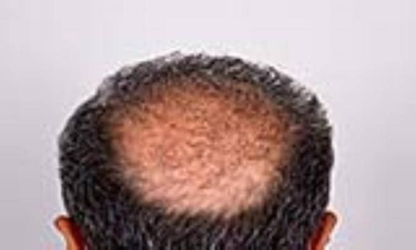 علل آلوپسی اسکار